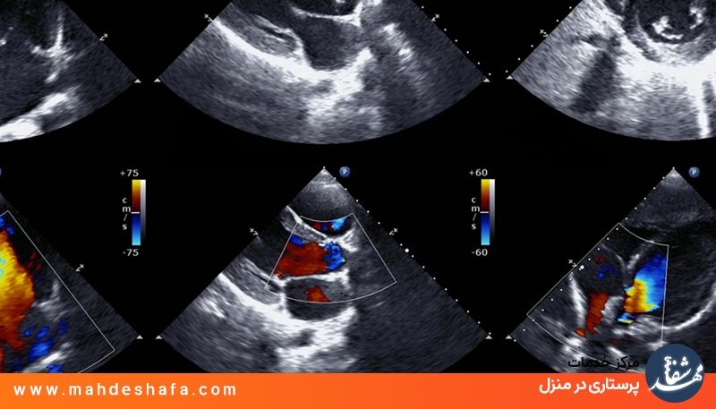 تجهیزات اکوی قلب در منزل