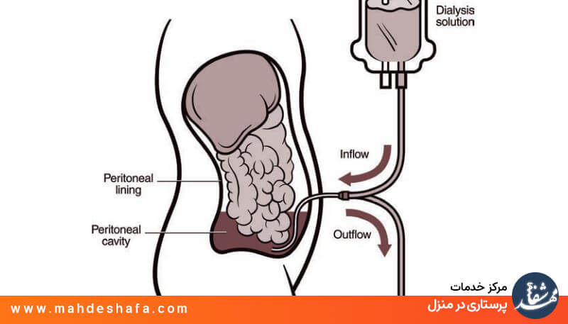 دیالیز صفاقی در منزل