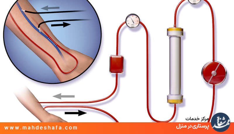 همودیالیز در خانه در تهران