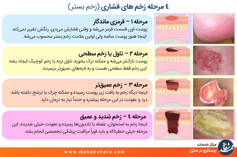 مراحل زخم های فشاری و زخم بستر