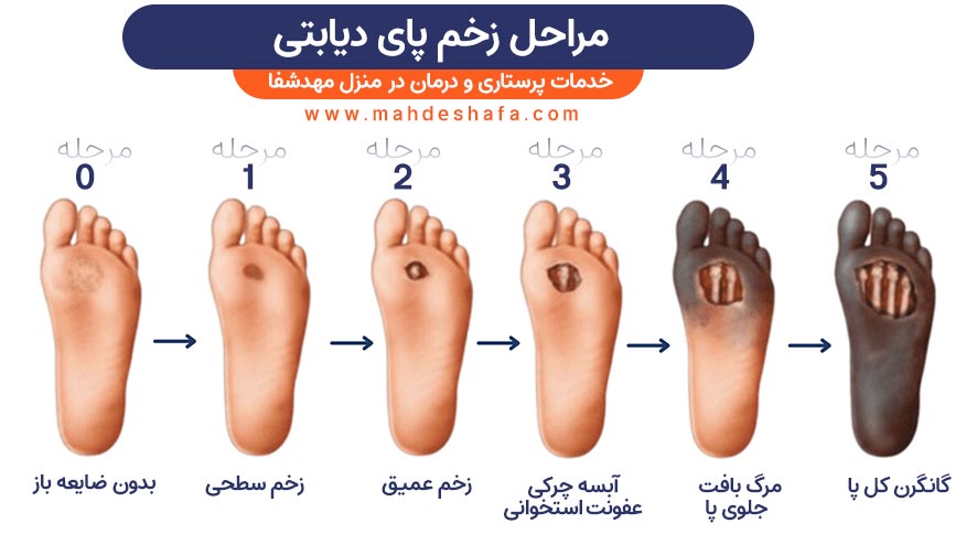 مراحل-زخم-پای-دیابتی