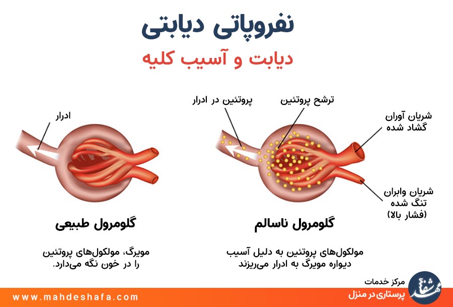 دیابت-و-اسیب-به-کلیه-ها