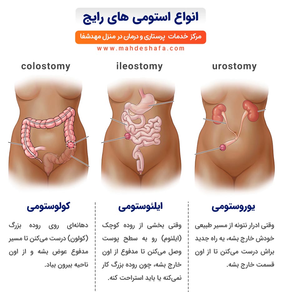 انواع-استومی-های-رایج