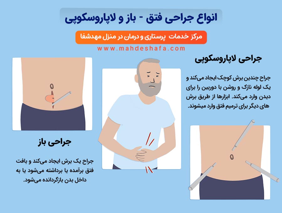 انواع-جراحی-فتق-باز-و-لاپاروسکوپی