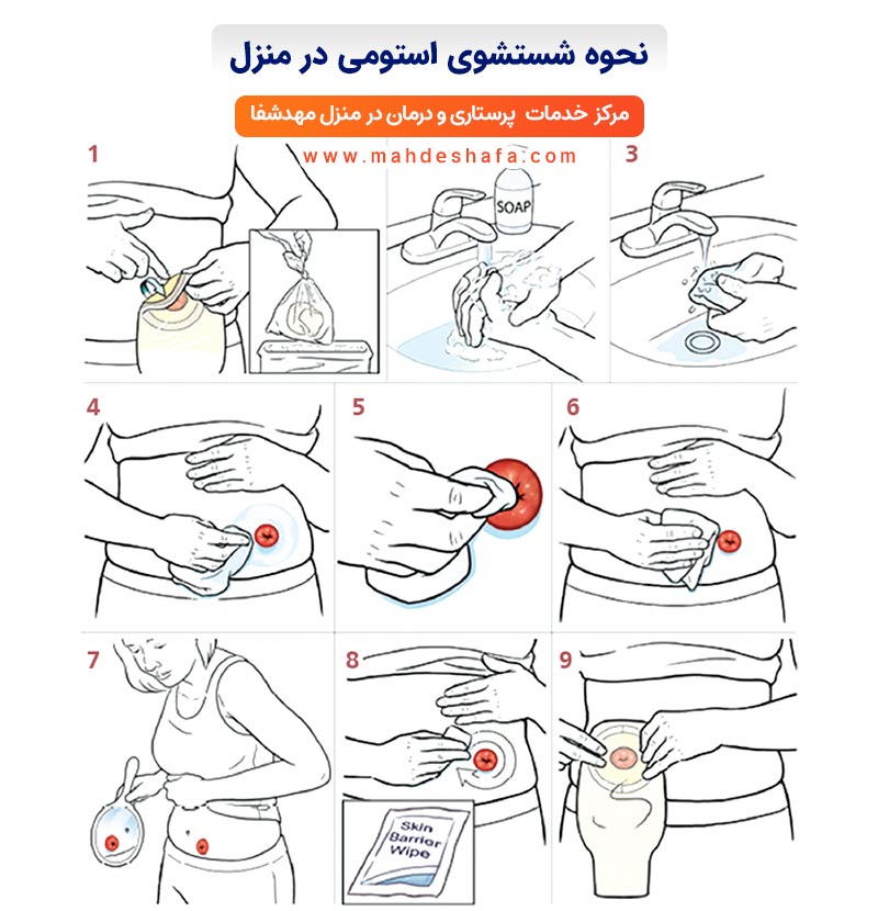 نحوه-شستشوی-استومی-در-منزل