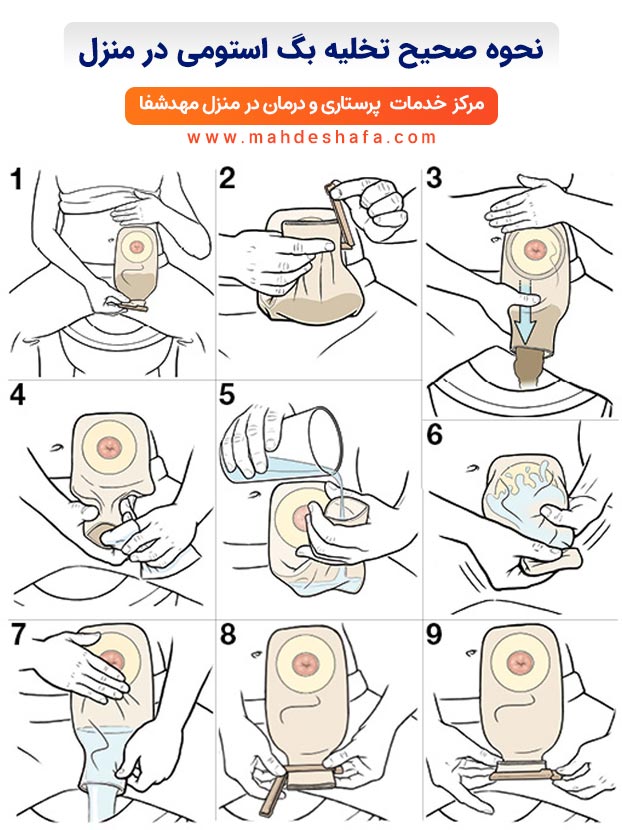 نحوه-صحیح-تخلیه-بگ-استومی-در-منزل