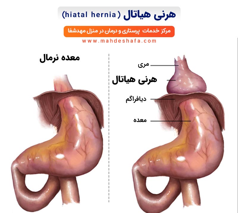 هرنی-هیاتال-(hiatal-hernia)