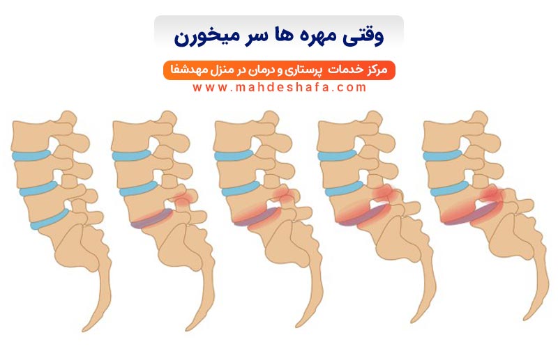 وقتی مهره ها سر میخورن