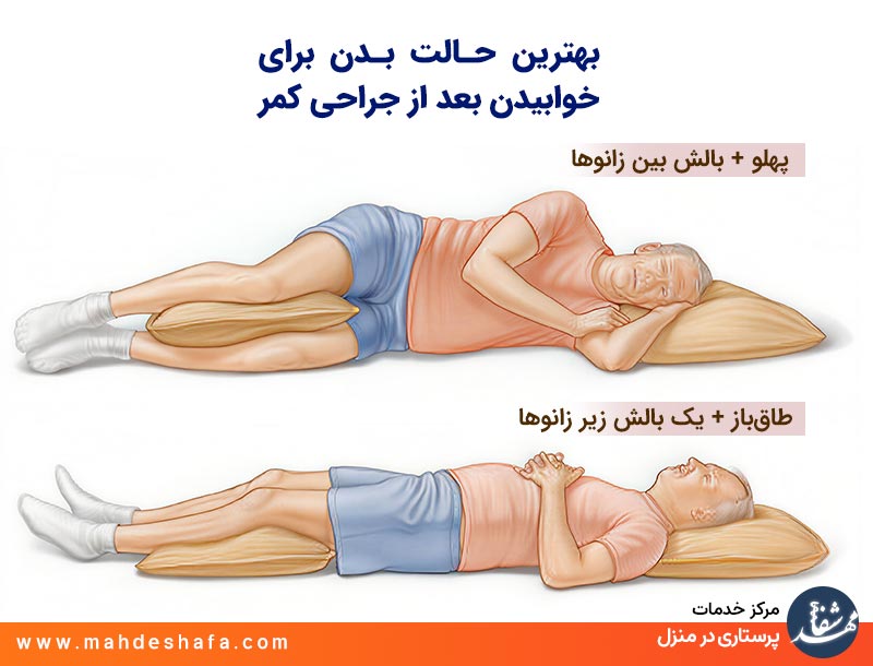 بهترین-حالت-بدن-برای-خوابیدن-بعد-از-جراحی-کمر