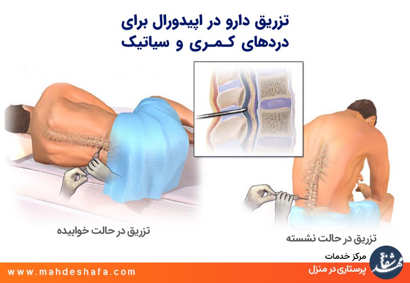 تزریق-دارو-در-اپیدورال-برای-دردهای-کمری-و-سیاتیک