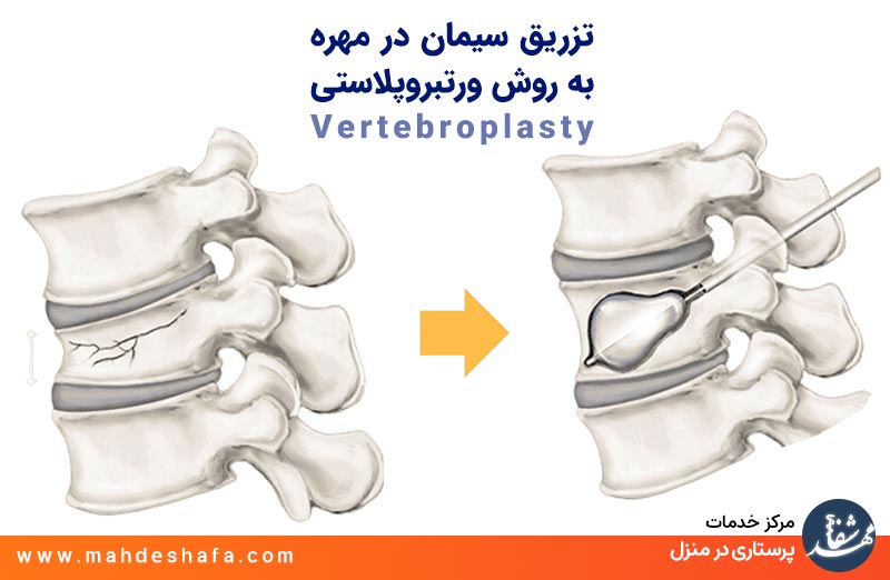 تزریق-سیمان-در-مهره-به-روش-ورتبروپلاستی-Vertebroplasty