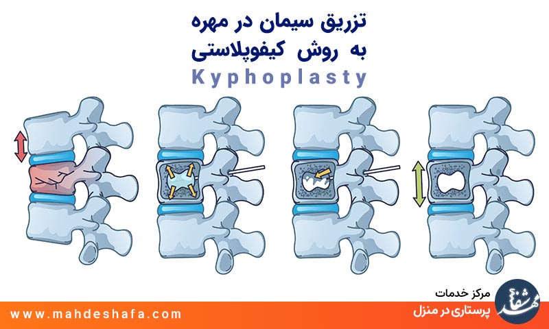 تزریق-سیمان-در-مهره-به-روش-کیفوپلاستی-Kyphoplasty