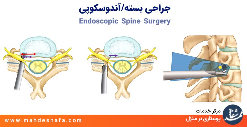جراحی-بسته-یا-آندوسکوپی--Endoscopic-Spine-Surgery