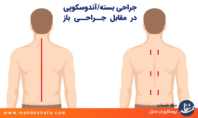جراحی-بسته-یا-آندوسکوپی-در-مقابل-جراحی-باز