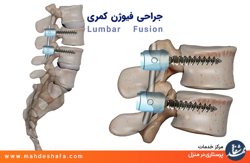 جراحی-فیوژن-کمری-Lumbar-Fusion
