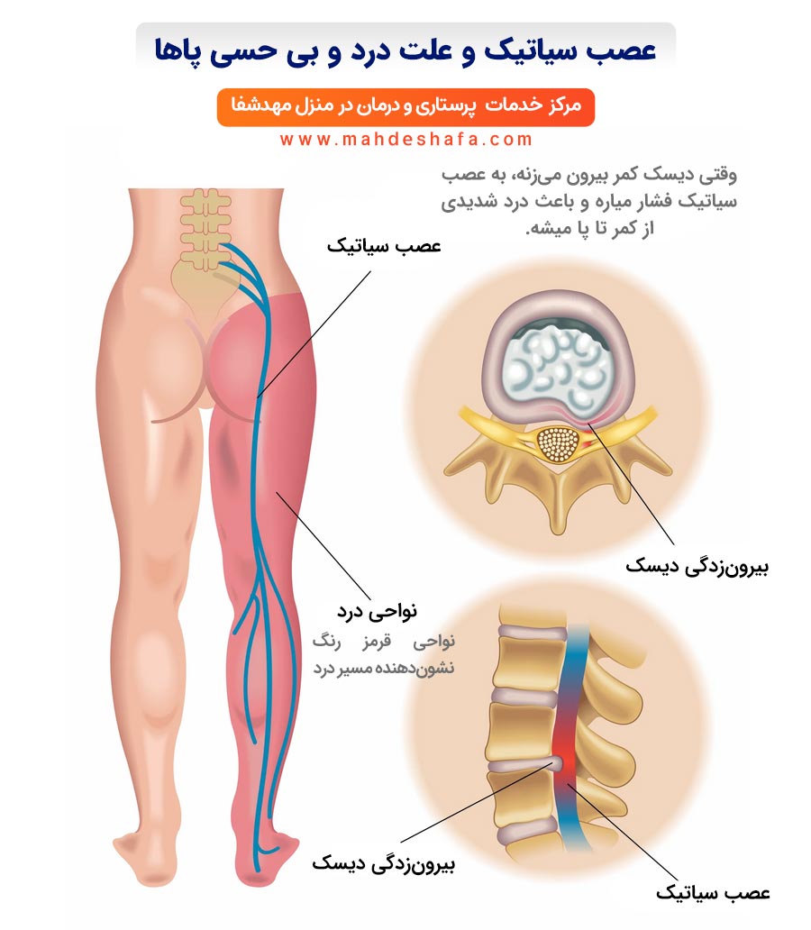 عصب-سیاتیک-و-علت-درد-و-بی-حسی-پاها