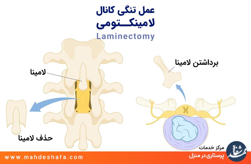 عمل-تنگی-کانال-نخاعی-لامینکتومی-Laminectomy