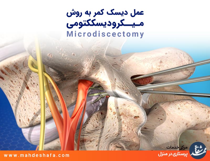 عمل-دیسک-کمر-به-روش-مـیــکرودیسککتومی-Microdiscectomy