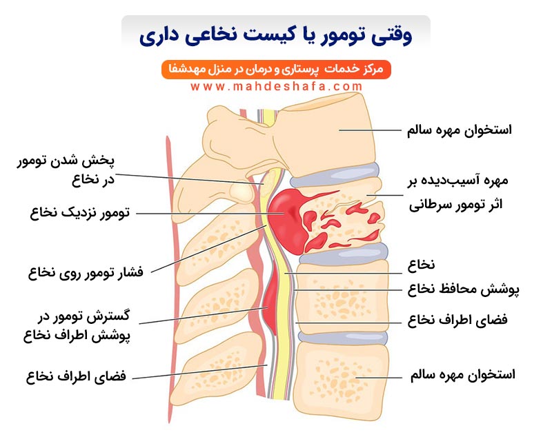 وقتی-تومور-یا-کیست-نخاعی-داری
