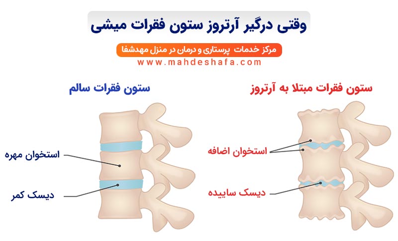 وقتی-درگیر-آرتروز-ستون-فقرات-میشی