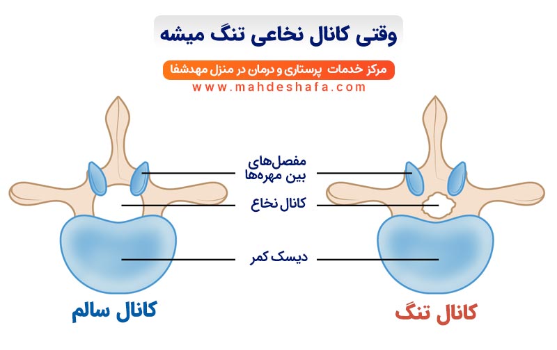 وقتی-کانال-نخاعی-تنگ-میشه