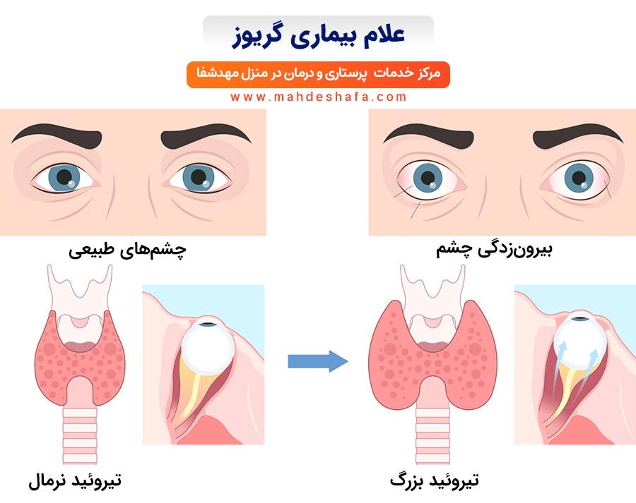 علام-بیماری-گریوز